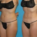 Liposuction #1 - Before and After