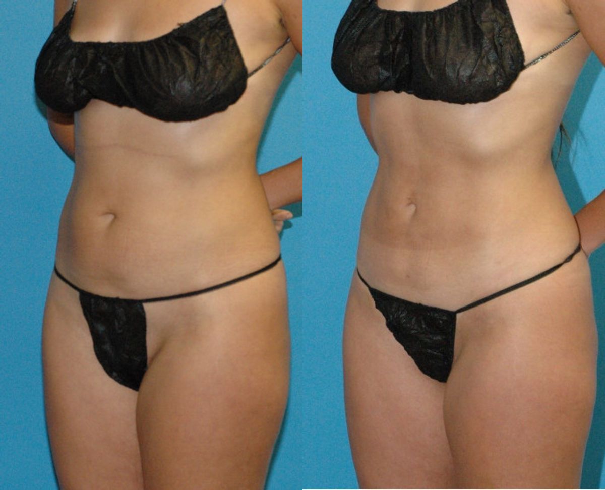 Liposuction #1 - Before and After