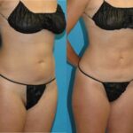 Liposuction #1 - Before and After