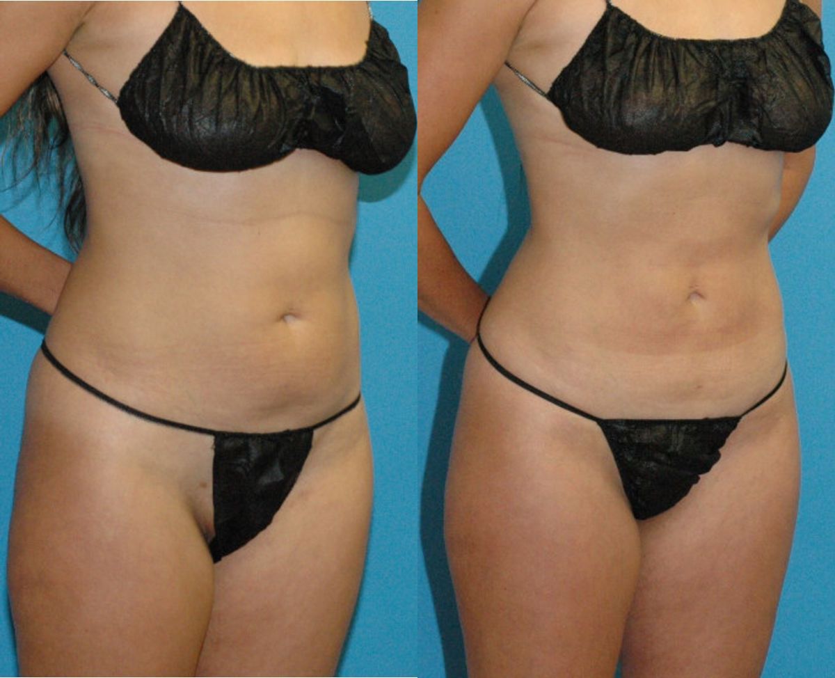 Liposuction #1 - Before and After