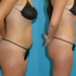 Liposuction #1 - Before and After