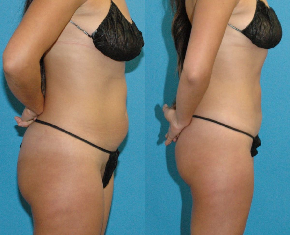 Liposuction #1 - Before and After