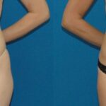 Liposuction #2 - Before and After