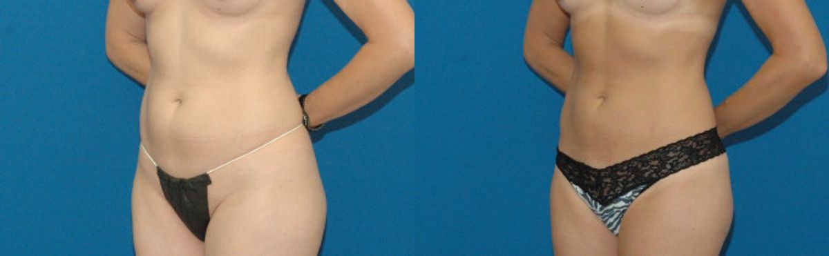 Liposuction #2 - Before and After