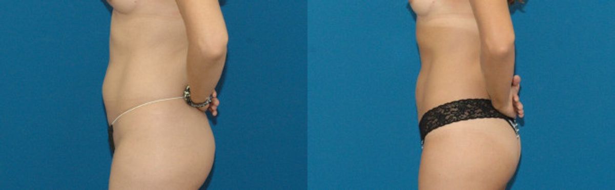 Liposuction #2 - Before and After