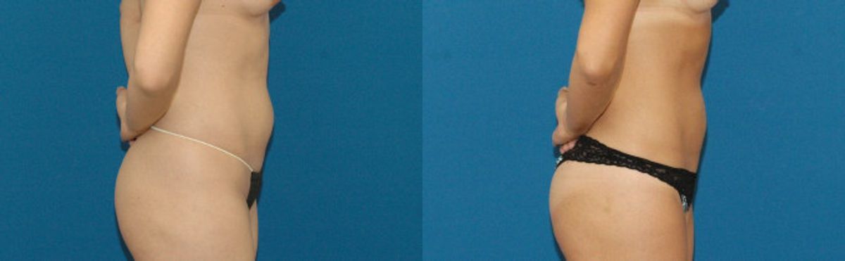 Liposuction #2 - Before and After