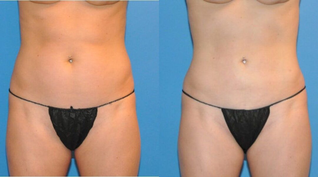 Liposuction #3