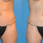 Liposuction #3 - Before and After