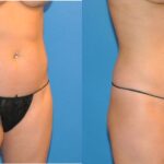 Liposuction #3 - Before and After