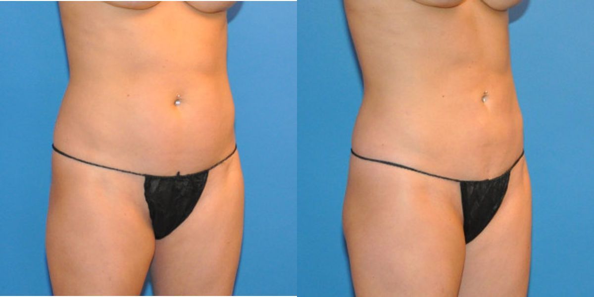 Liposuction #3 - Before and After