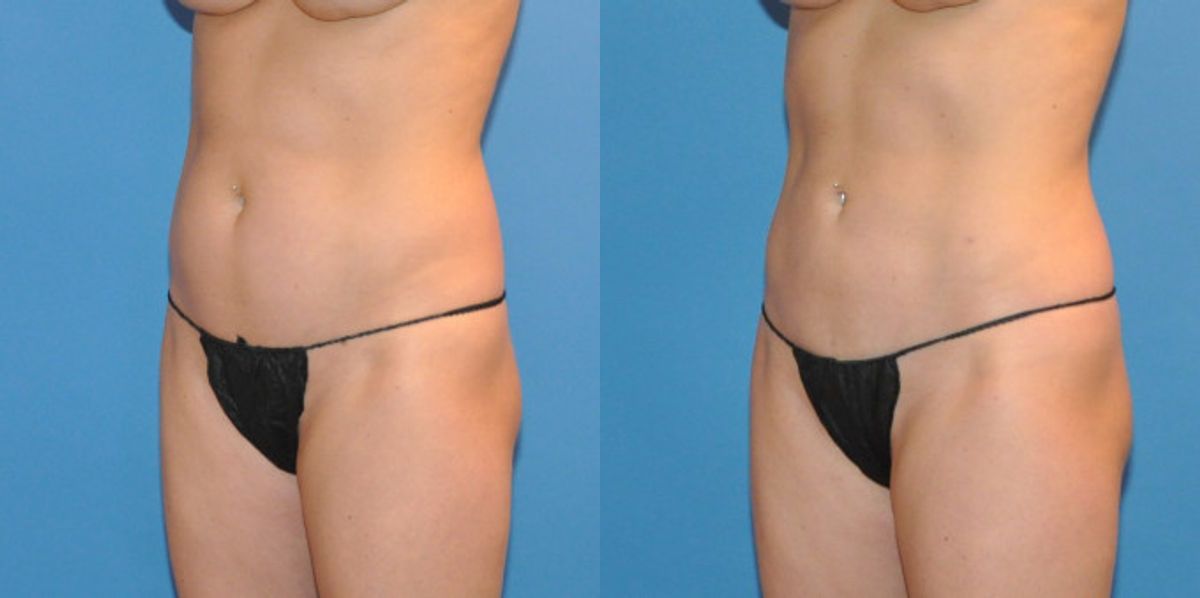 Liposuction #3 - Before and After