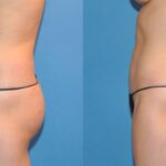 Liposuction #3 - Before and After