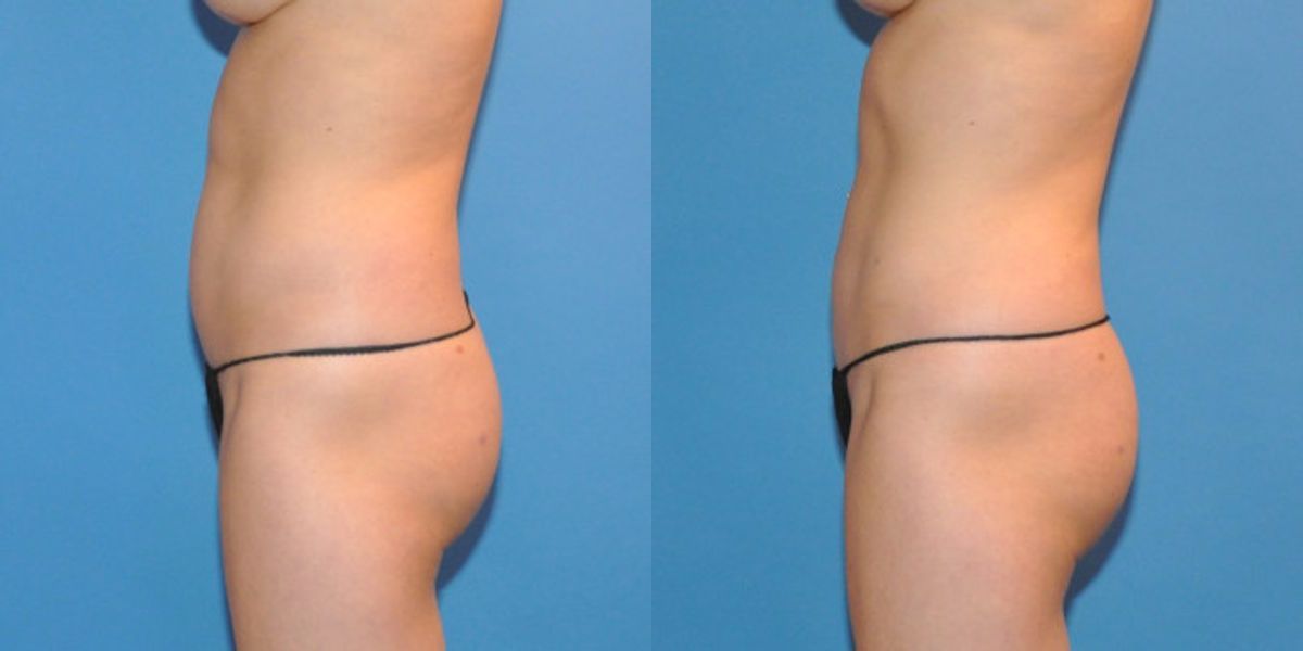 Liposuction #3 - Before and After