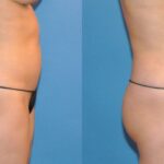 Liposuction #3 - Before and After