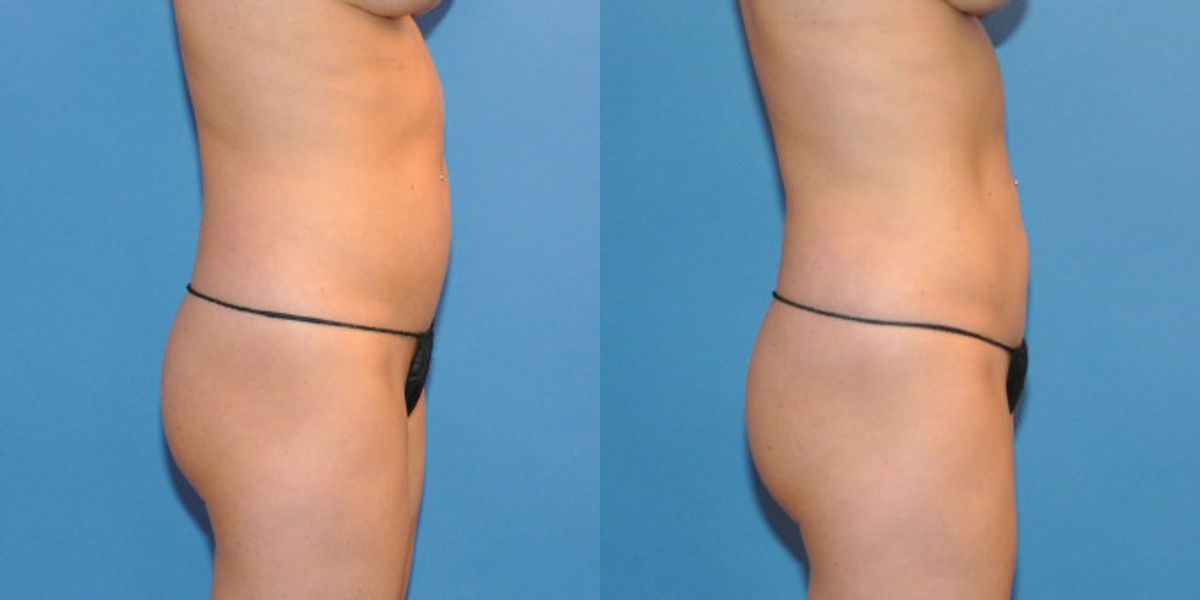 Liposuction #3 - Before and After