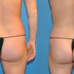 Liposuction #3 - Before and After