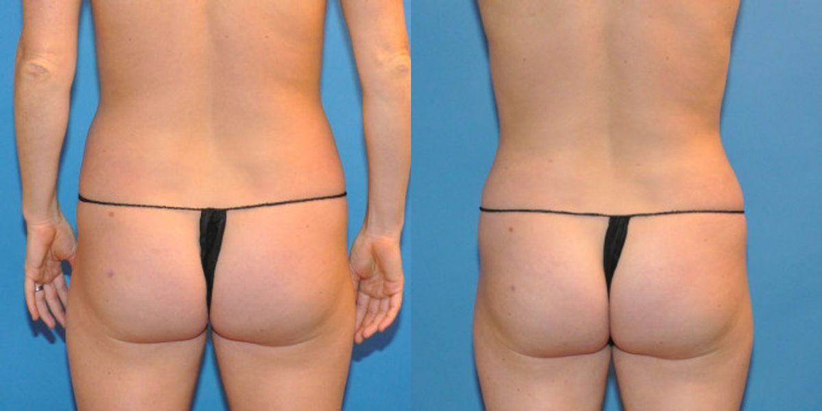 Liposuction #3 - Before and After