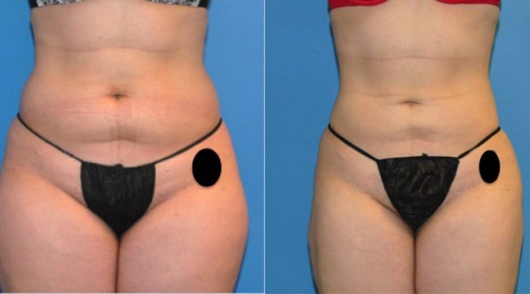 Liposuction #4