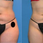 Liposuction #4 - Before and After