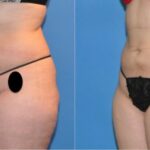 Liposuction #4 - Before and After