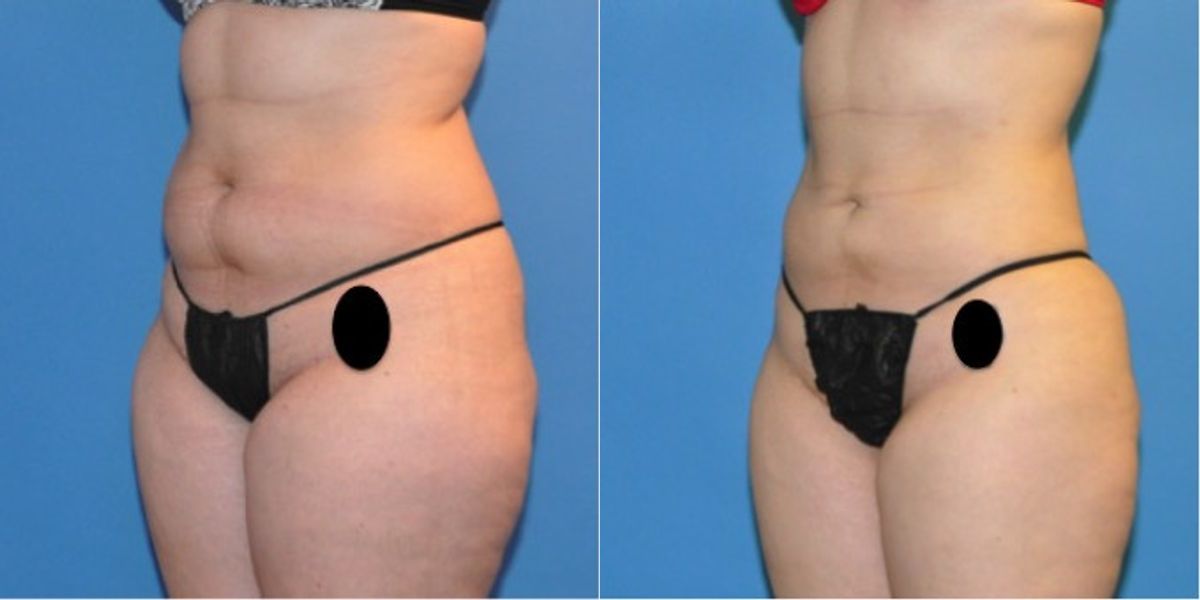 Liposuction #4 - Before and After