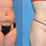 Liposuction #4 - Before and After