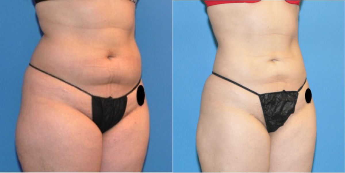 Liposuction #4 - Before and After