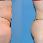 Liposuction #4 - Before and After
