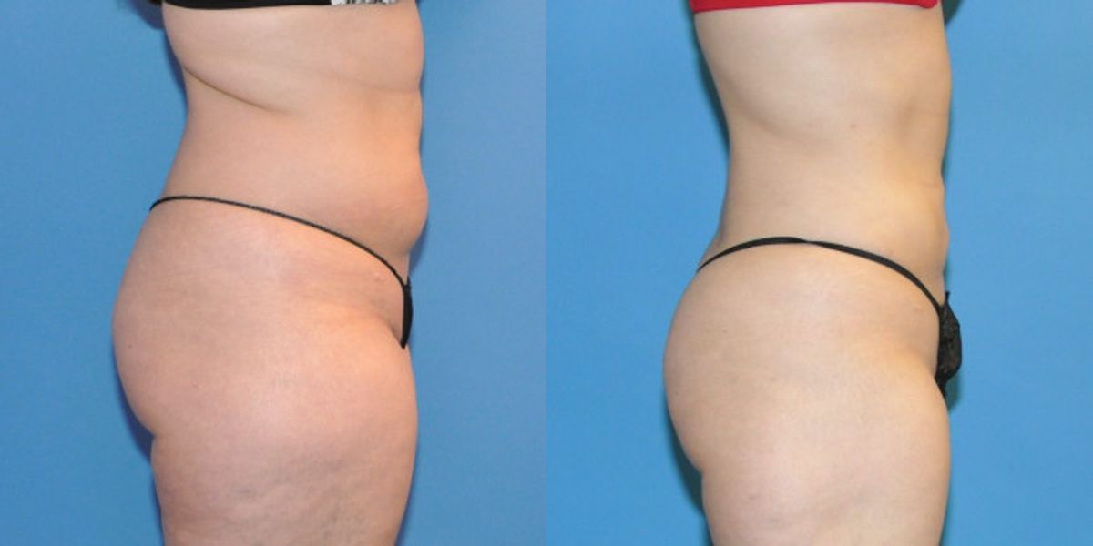 Liposuction #4 - Before and After