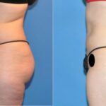 Liposuction #4 - Before and After