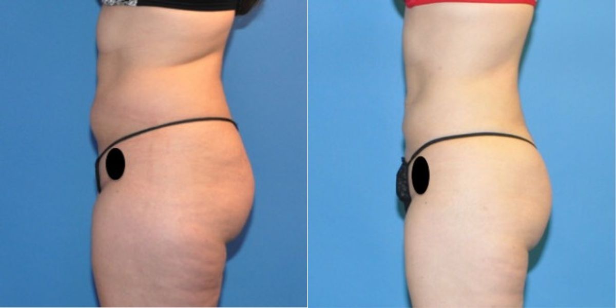 Liposuction #4 - Before and After