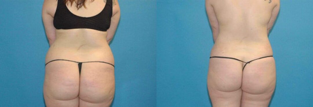 Liposuction #5