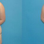 Liposuction #5 - Before and After