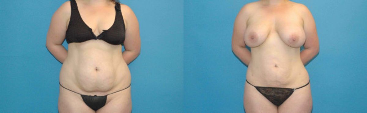 Liposuction #5 - Before and After