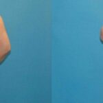 Liposuction #5 - Before and After