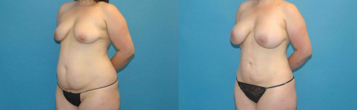 Liposuction #5 - Before and After