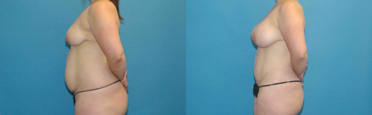 Liposuction #5 - Before and After