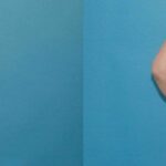 Liposuction #5 - Before and After