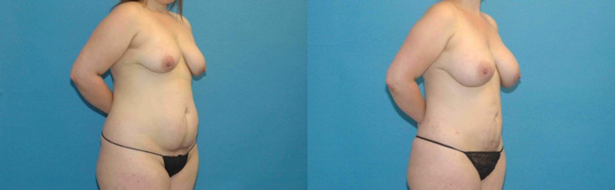 Liposuction #5 - Before and After