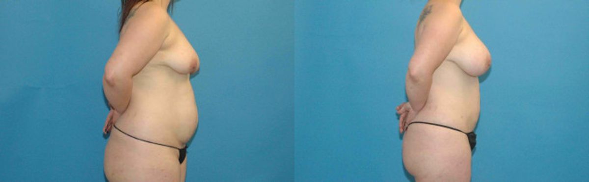 Liposuction #5 - Before and After