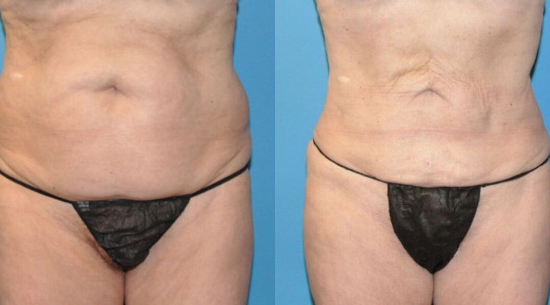 Liposuction #6