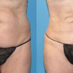 Liposuction #6 - Before and After
