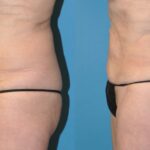 Liposuction #6 - Before and After