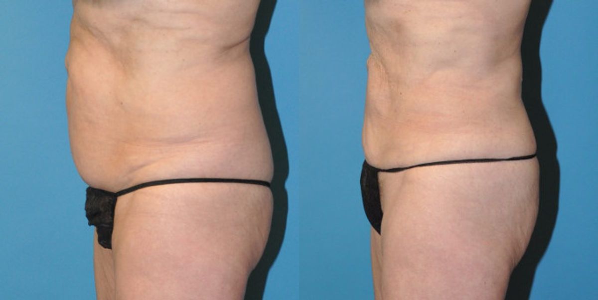 Liposuction #6 - Before and After