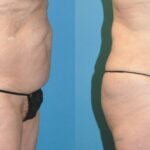 Liposuction #6 - Before and After