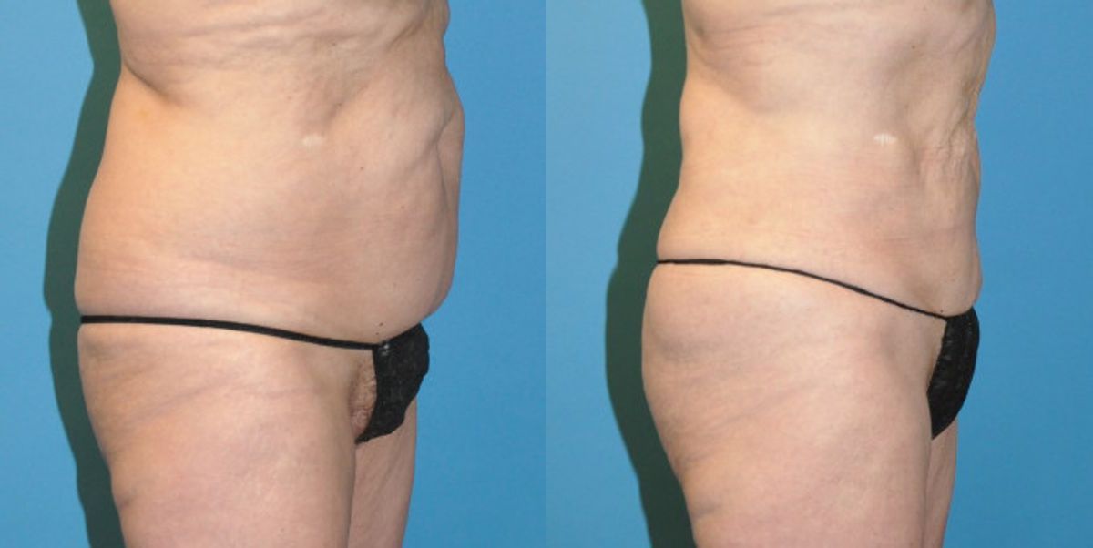 Liposuction #6 - Before and After