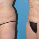 Liposuction #6 - Before and After