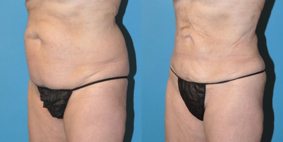 Liposuction #6 - Before and After