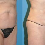 Liposuction #6 - Before and After