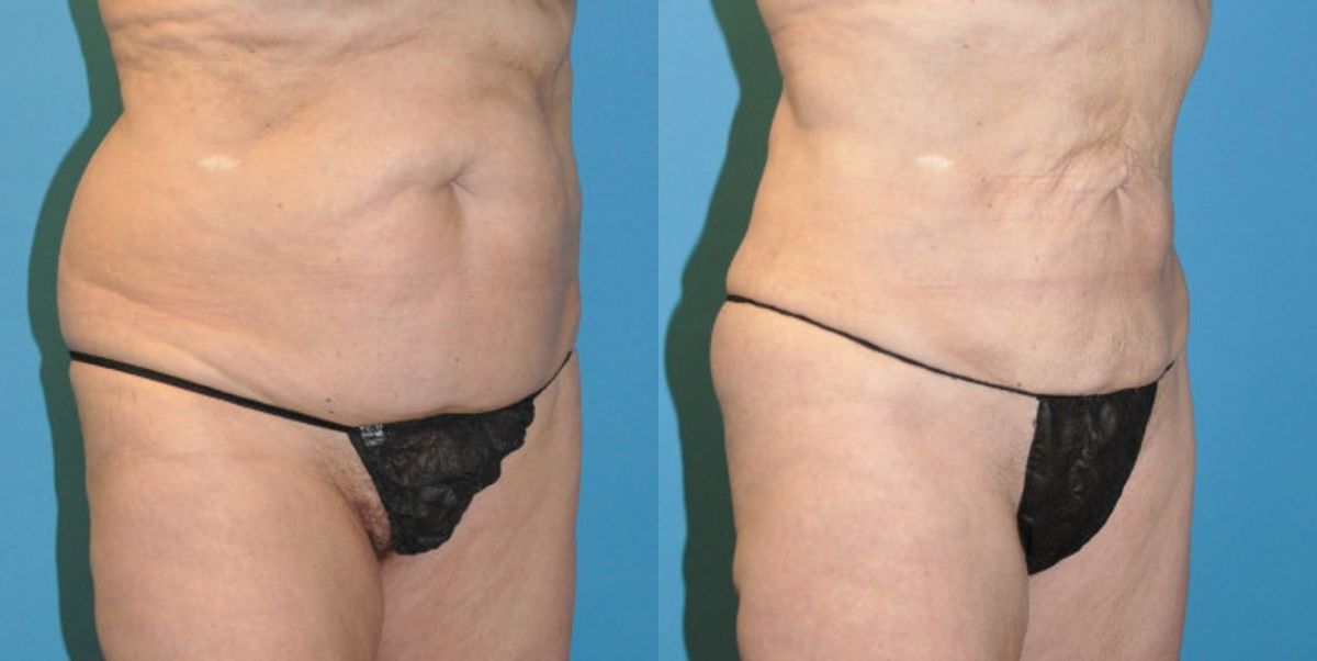Liposuction #6 - Before and After